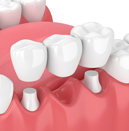 Dental Bridges | Lynnwood Dental | General & Family Dentist | SE Calgary