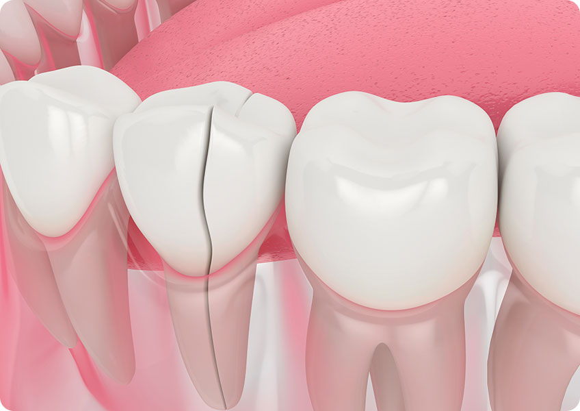 Dental Crowns | Lynnwood Dental | General & Family Dentist | SE Calgary