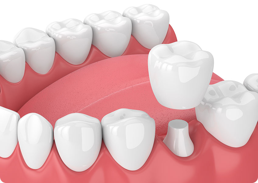 Dental Crowns | Lynnwood Dental | General & Family Dentist | SE Calgary