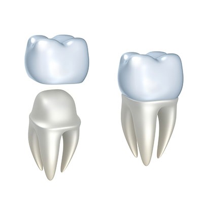 Dental Crowns | Lynnwood Dental | General & Family Dentist | SE Calgary