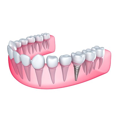 Dental Implants | Lynnwood Dental | General & Family Dentist | SE Calgary