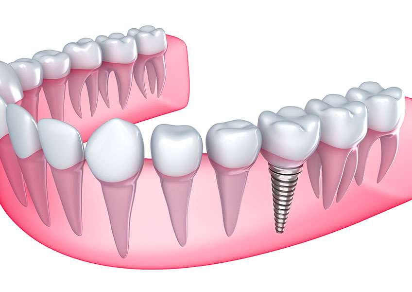 Dental Implants | Lynnwood Dental | General & Family Dentist | SE Calgary