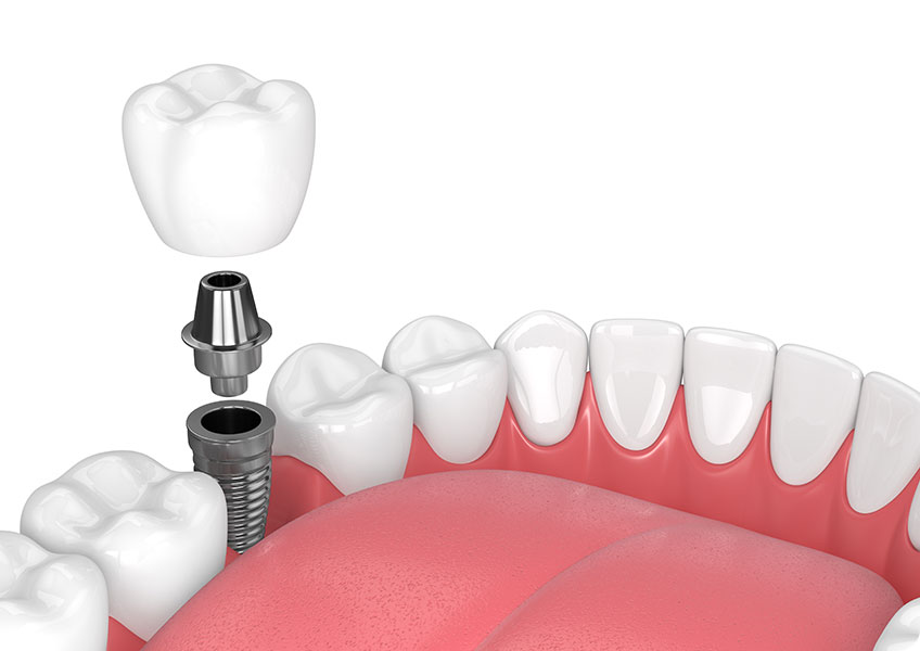 Dental Implants | Lynnwood Dental | General & Family Dentist | SE Calgary