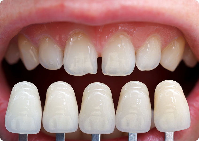 Porcelain Veneers | Lynnwood Dental | General & Family Dentist | SE Calgary