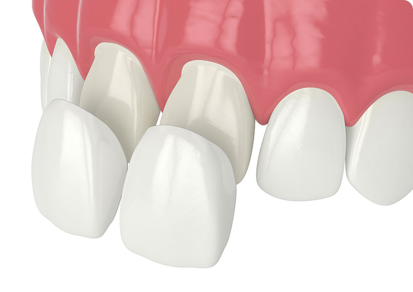 Porcelain Veneers | Lynnwood Dental | General & Family Dentist | SE Calgary