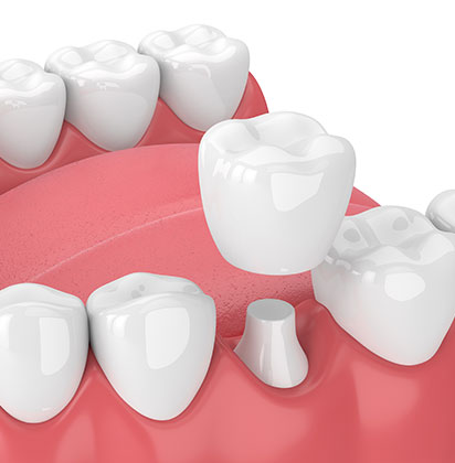 Restorative Dentistry | Lynnwood Dental | General & Family Dentist | SE Calgary