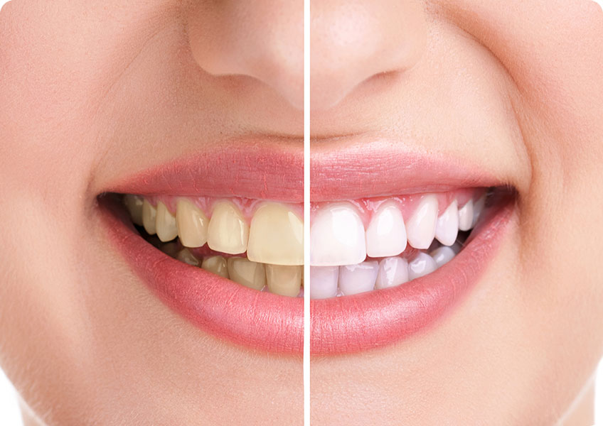 Teeth Whitening | Lynnwood Dental | General & Family Dentist | SE Calgary