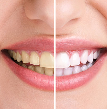 Teeth Whitening | Lynnwood Dental | General & Family Dentist | SE Calgary